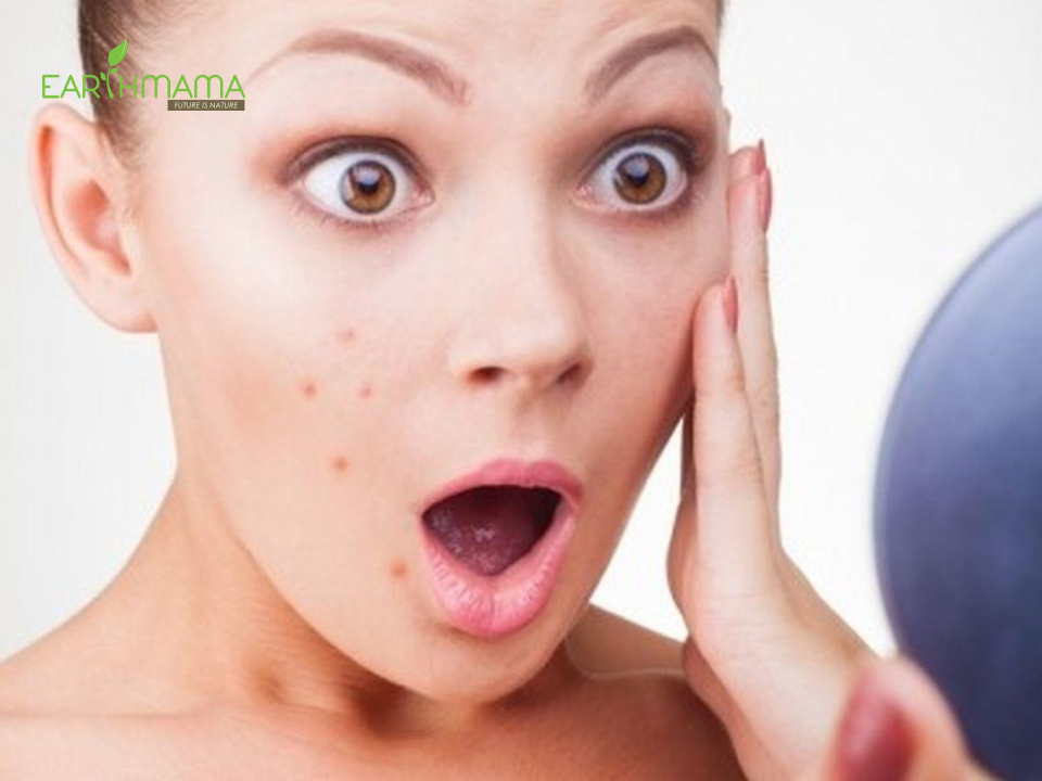 Mụn thường biểu hiện bằng các vết sưng đỏ và gây đau đớn