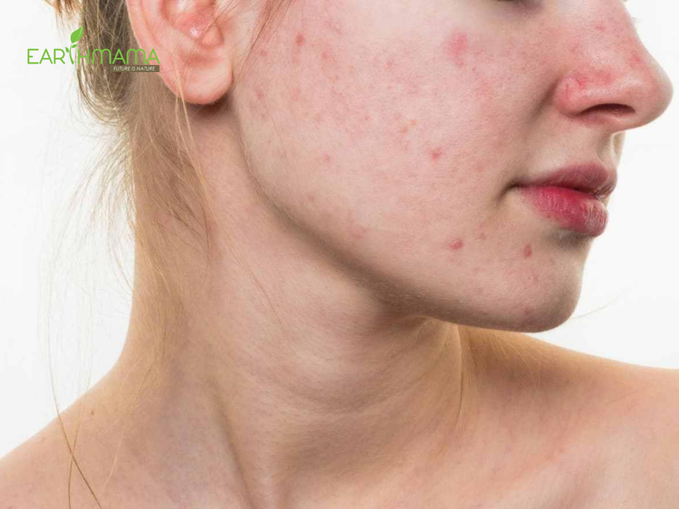 Mụn khi mang thai là tình trạng rất thường gặp