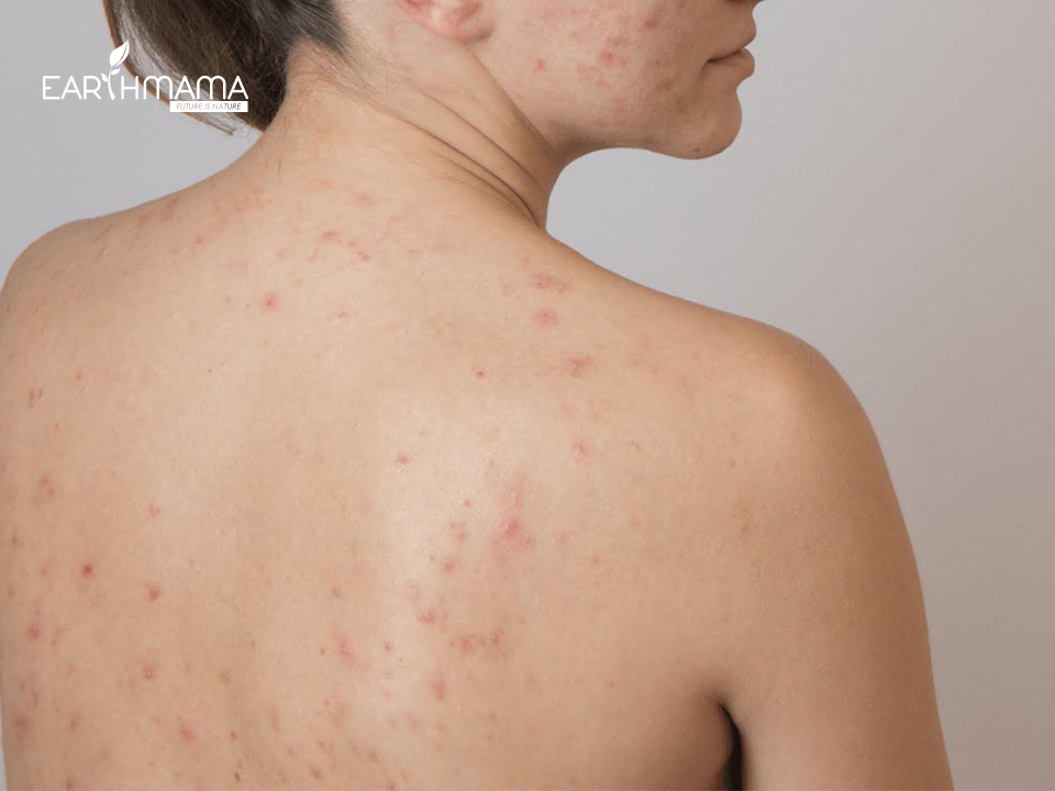 Hướng dẫn cách trị mụn lưng sau sinh hiệu quả