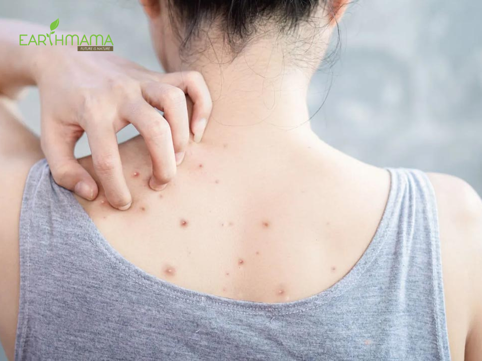 Lưu ý khí trị mụn lưng sau sinh và cách chăm sóc