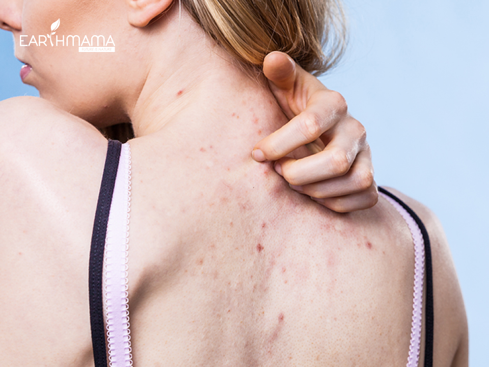Nguyên nhân gây mụn lưng và cách trị mụn lưng sau sinh đúng cách