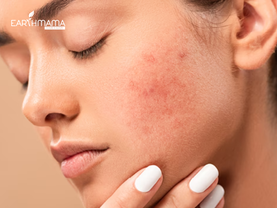 Da mặt sau sinh thường bị sần, nám và mụn