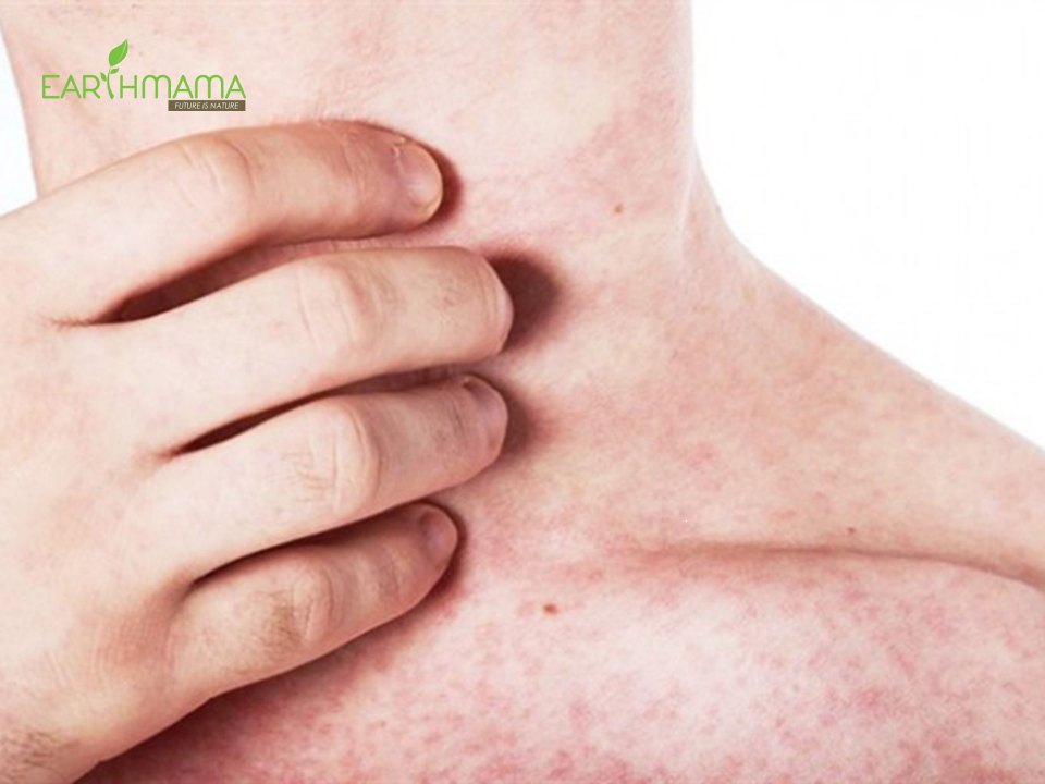 Rôm sảy, mẩn ngứa làm mẹ khó chịu, ngứa ngáy