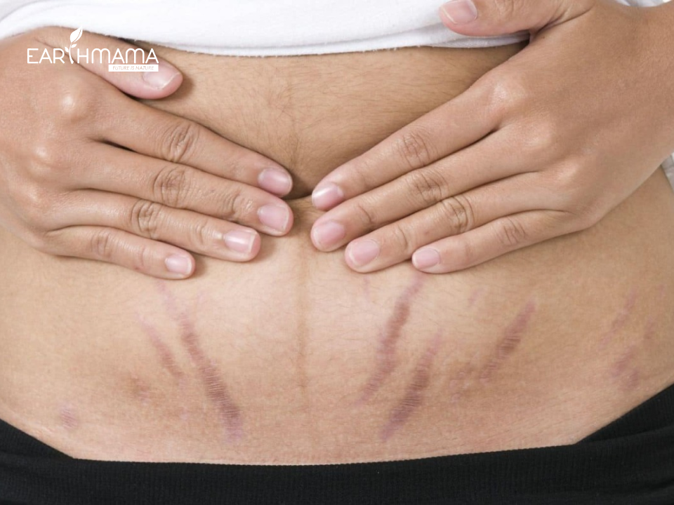 Những vết rạn không thể loại bỏ trên da mẹ sau sinh