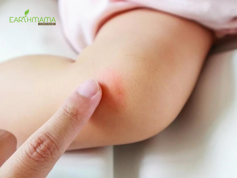thoa dầu khuynh diệp cho trẻ sơ sinh trị côn trùng đốt hiệu quả